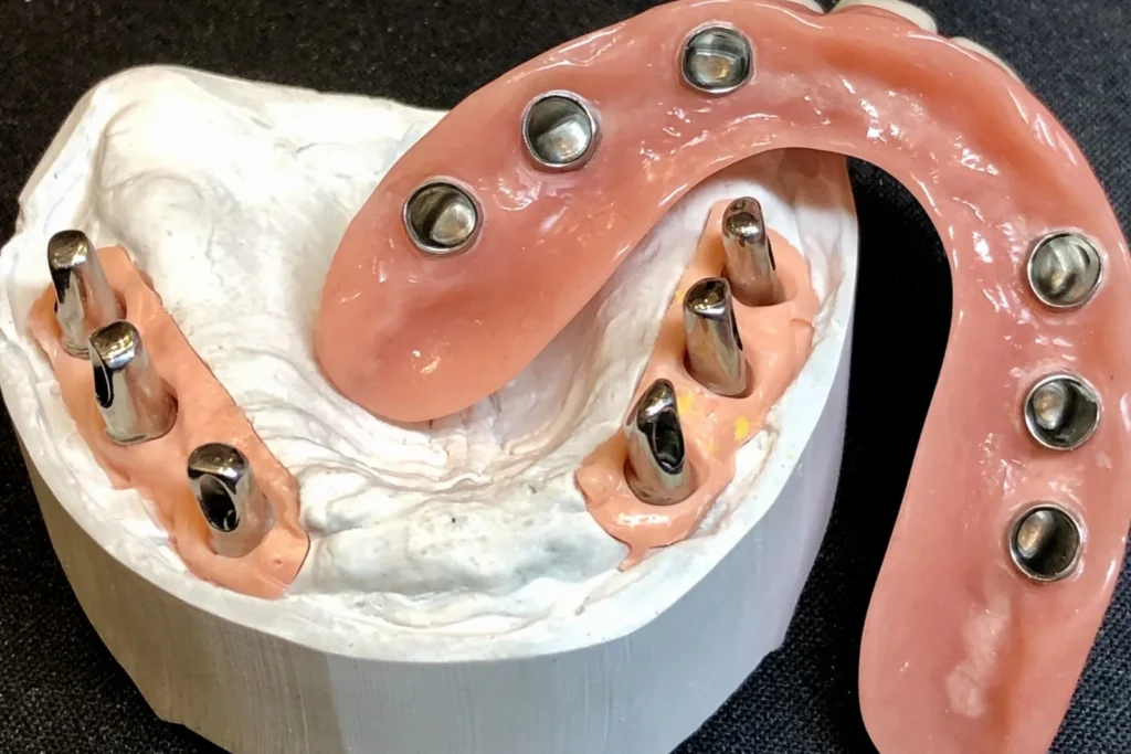 Implantatgetragener Steg mit zugehöriger Prothese