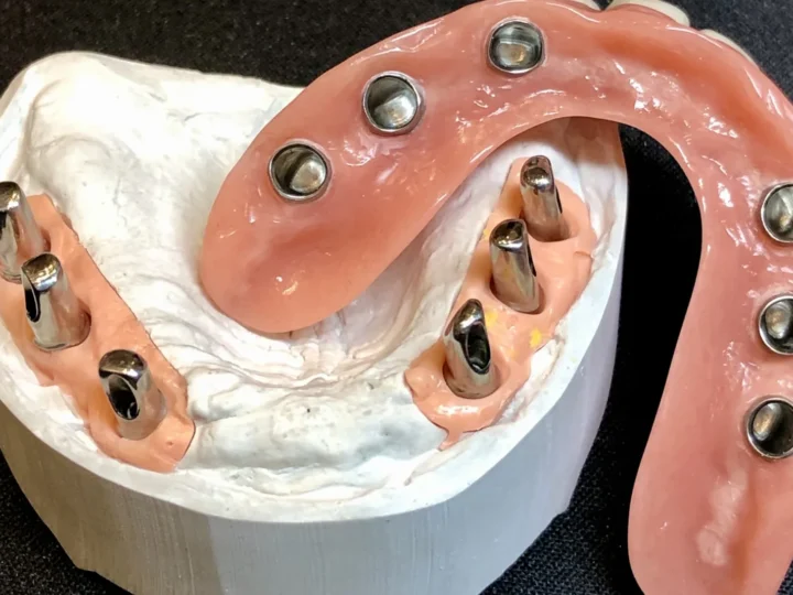 Implantatgetragener Steg mit zugehöriger Prothese