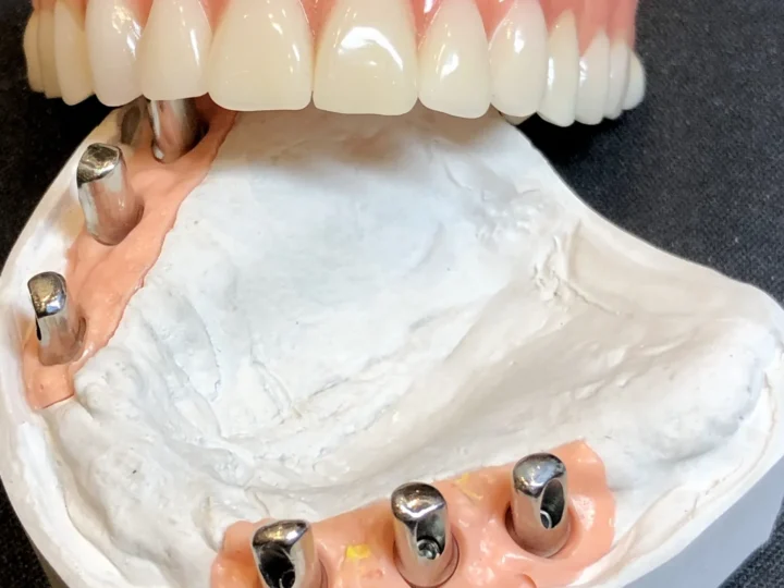 Implantatgetragene Versorgung des Oberkiefers auf dem Modell