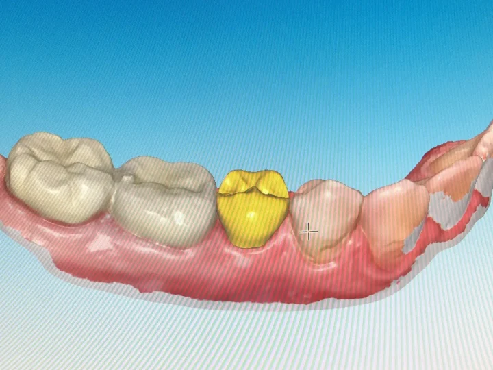 Digitaler Scan eines Unterkiefers mit geplanter Versorgung